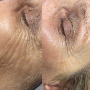 Erbium Laser Skin Resurfacing