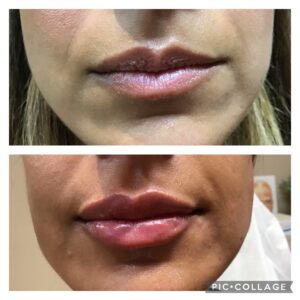 Juvederm Ultra for Lips