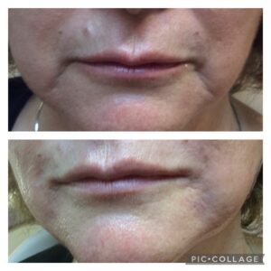 Juvederm Ultra for Marionette lines