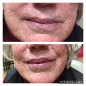 Juvederm before and after