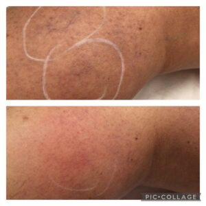 Laser Spider Vein Removal
