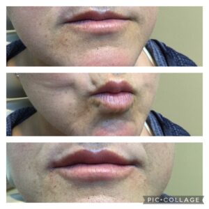 Lip Correction with Versa Filler