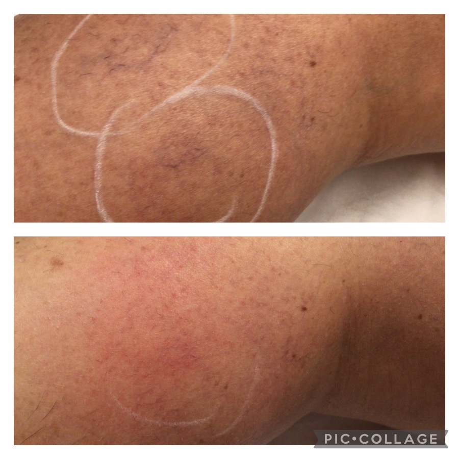 Laser Spider Vein Removal