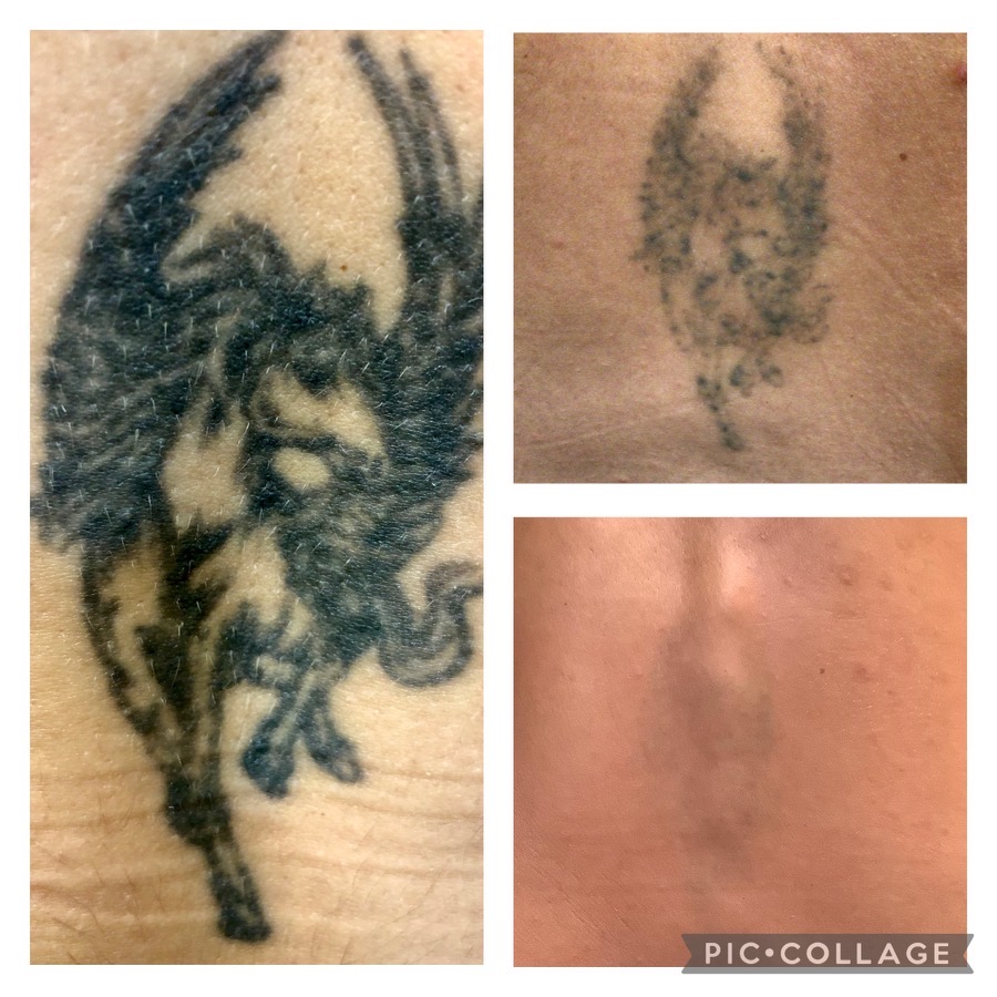 Tattoo Removal after 4 and 10 treatments